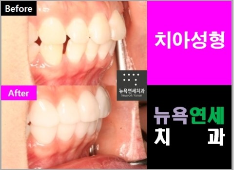  ##앞니교정방법,치과앞니교정,앞니성형치과,치아성형방법##