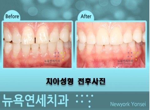  ##라미네이트시술,라미네이트치료,앞니라미네이트치료,앞니라미네이트성형##