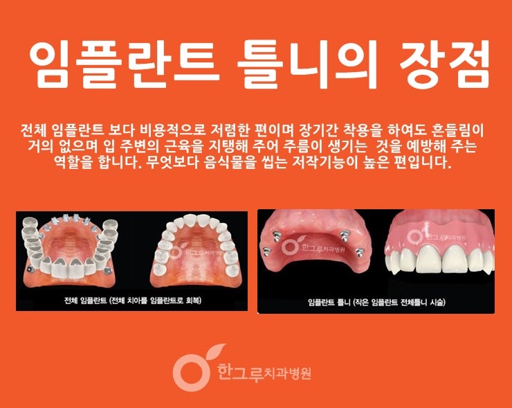 목동치과에서 어금니 임플란트 틀니를 올린 과정을 보여드리겠습니다.