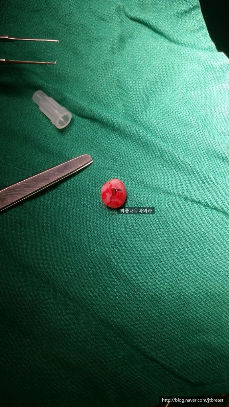 두피 피지낭종 핀홀법 제거하기, 도곡동 외과 : 네이버 블로그 두피 피지낭종 핀홀법 제거하기, 도곡동 외과 : 네이버 블로그