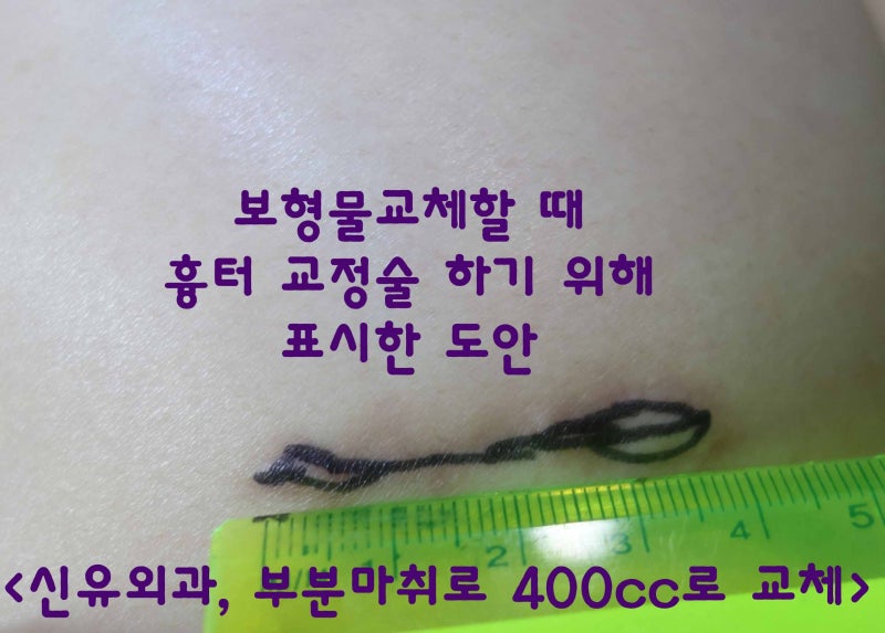 부분마취로 물방울보형물280cc를 스무스400cc로 교체한 분 : 수술중간에 본인 눈으로 확인하고 만져보시기까지 함.