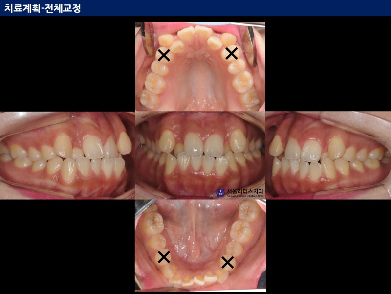 발치교정 시 작은 어금니 치아 4개 한 번에 뽑나요? : 네이버 블로그 발치교정 시 작은 어금니 치아 4개 한 번에 뽑나요? : 네이버 블로그