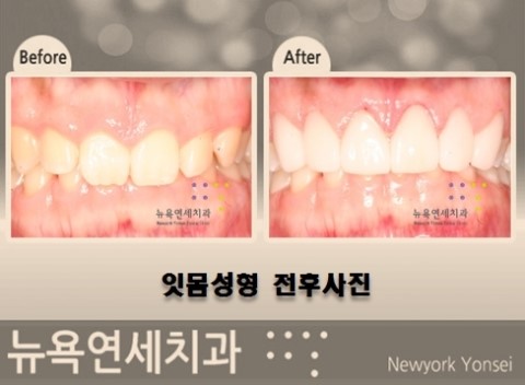  ##거미스마일잇몸성형,거미스마일수술,거미스마일시술,거미스마일치료##