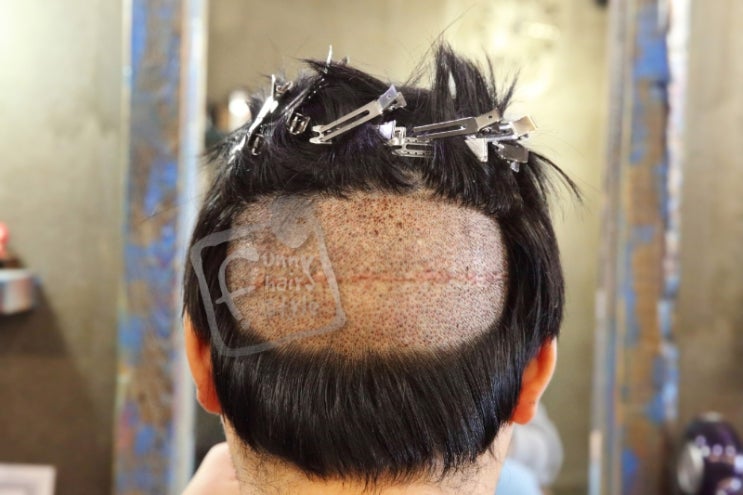  2차 비절개 모발이식 암흑기 후두부 퍼니M 테이프 스티커붙임머리