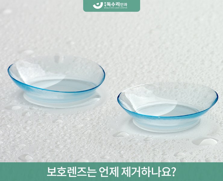 백현동안과 라섹후 보호렌즈 왜 착용할까? : 네이버 블로그 백현동안과 라섹후 보호렌즈 왜 착용할까? : 네이버 블로그