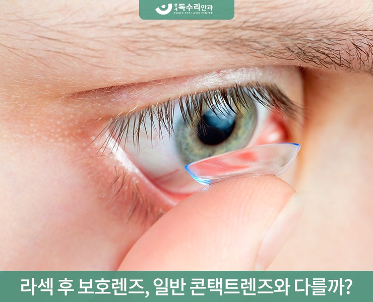 백현동안과 라섹후 보호렌즈 왜 착용할까? : 네이버 블로그 백현동안과 라섹후 보호렌즈 왜 착용할까? : 네이버 블로그