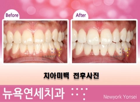  황니미백,누런치아미백,황니치아미백,선천적으로누런치아