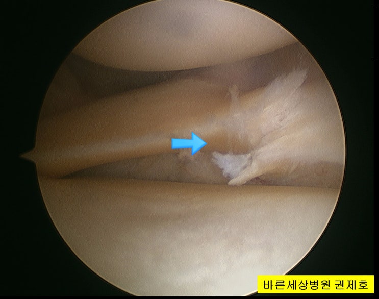 반월상 연골판 파열 관절경을 이용한 연골판 절제술 서울바른세상병원 권제호