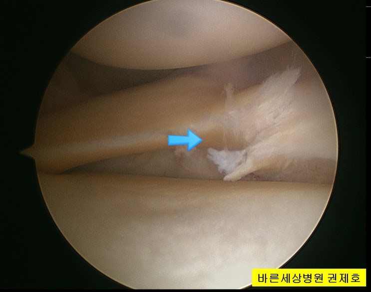  반월상 연골판 파열 관절경을 이용한 연골판 절제술 서울바른세상병원 권제호