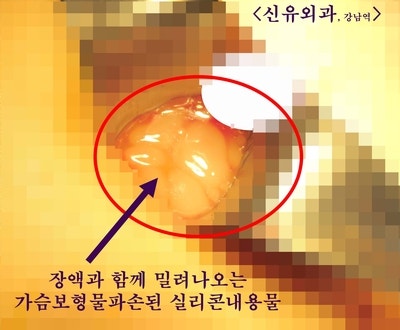 타병원에서 가슴보형물파손진단되어 오신 분 제거수술 : 뒷면 접합부위 구형구축없이