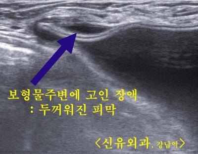 가슴보형물과 일부 극히 두꺼워진 피막을 같이 제거한 교체수술