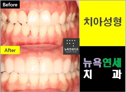  치아의 모양도 함께 교정을 하는 앞니 치아성형!