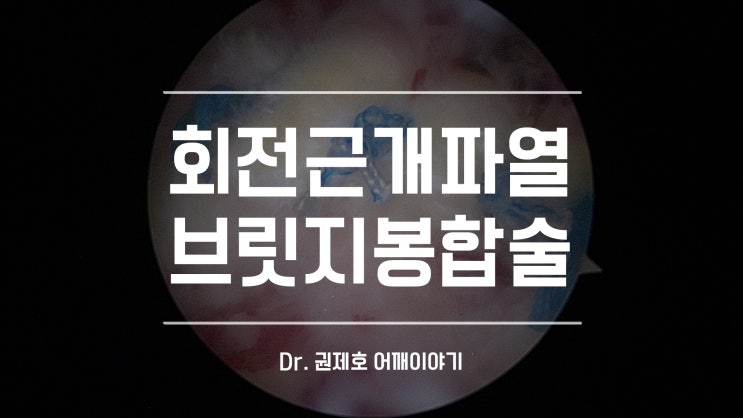  회전근개파열 후 전위된 어깨 인대의 봉합