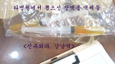 확대수술후 몇 년 후 갑자기 가슴이 커져서 부분마취로 보형물교체하고 이중피막제거