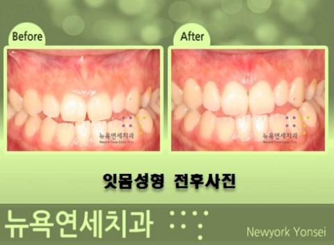  보기 싫은 거미스마일을 잇몸성형 수술로 개선을 해보세요.