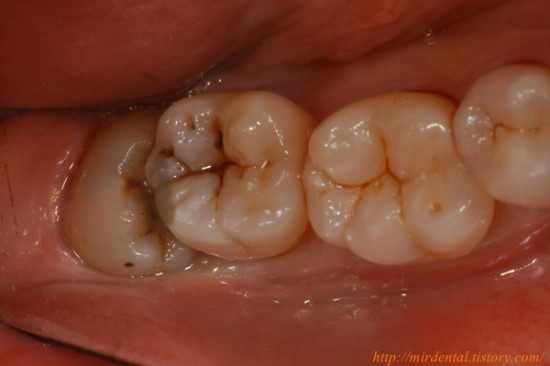  사랑니발치하세요! 두번하세요!wisdon tooth extraction!