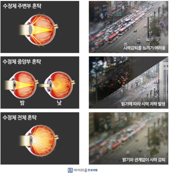 실명원인 1위! 백내장 완전 정복