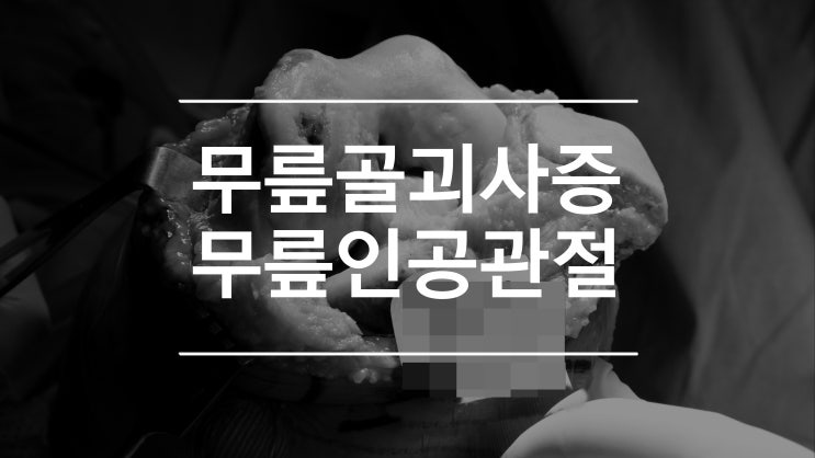  골괴사 무릎 뼈가 삭는 무릎통증 Osteonecrosis