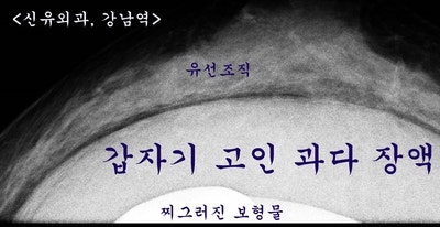 물방울보형물주변의 과다장액이 피막을 찢어서 멍울로 만져졌던 분