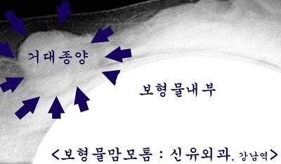 거대종양도 가슴보형물파손없이 안전하게 제거된 맘모톰수술