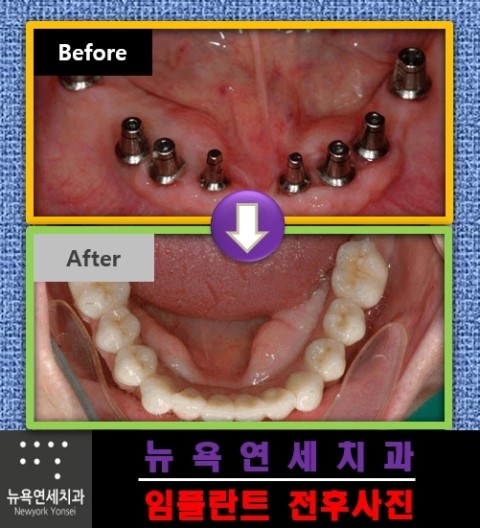  치아를 뽑고 난 다음에는 임플란트를 꼭 해야 할까요?