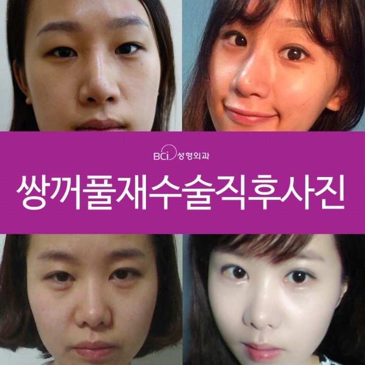 눈재수술성형외과 , 두번의 실패는 2
