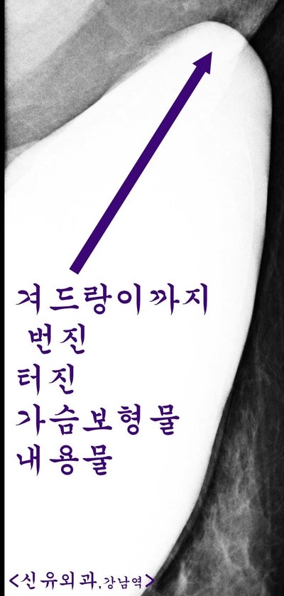 가슴보형물파손제거교체수술하고, 겨드랑이쪽 방을 막고, 2cm거상술까지 부분마취로 동시에