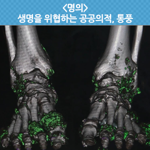  생명을 위협하는 공공의 적, 통풍 - EBS <명의>