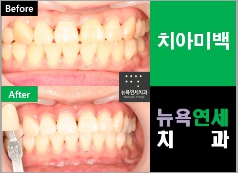 치아미백 프로그램 종류 중에서 단기간에 받는 스피드업 치아미백 사례