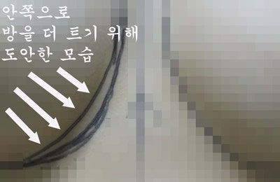 회전된 물방울가슴보형물을 부분마취하여 스무스로 교체하고 흉터교정술해 드린 분