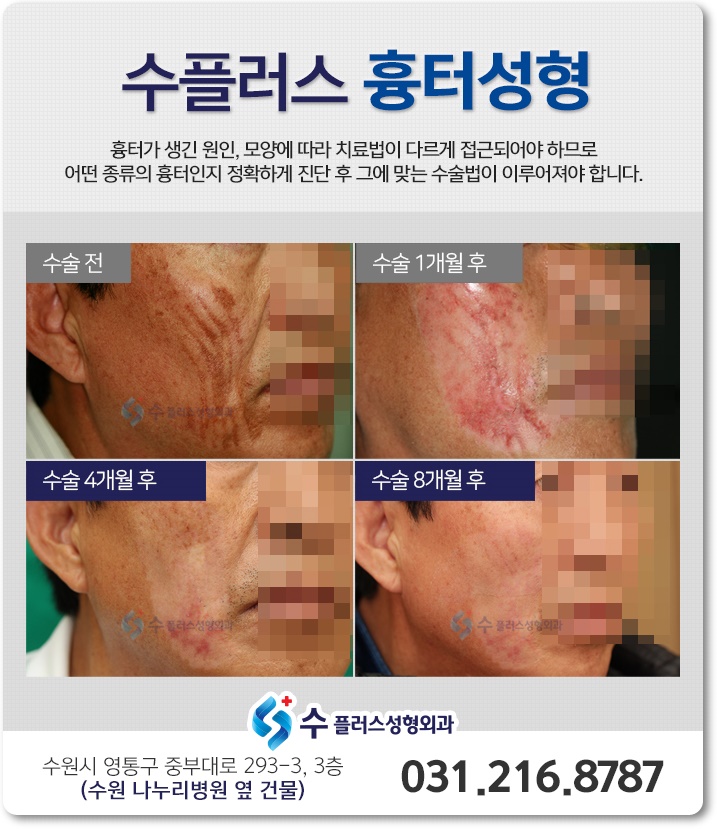 안면흉터제거 5세트 + 세침침 시술 후(시간, 비용)