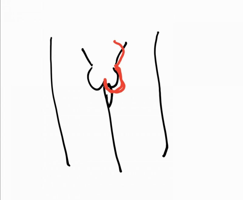 우왕좌왕하는 신생아 서경부 탈장 수술 리뷰.