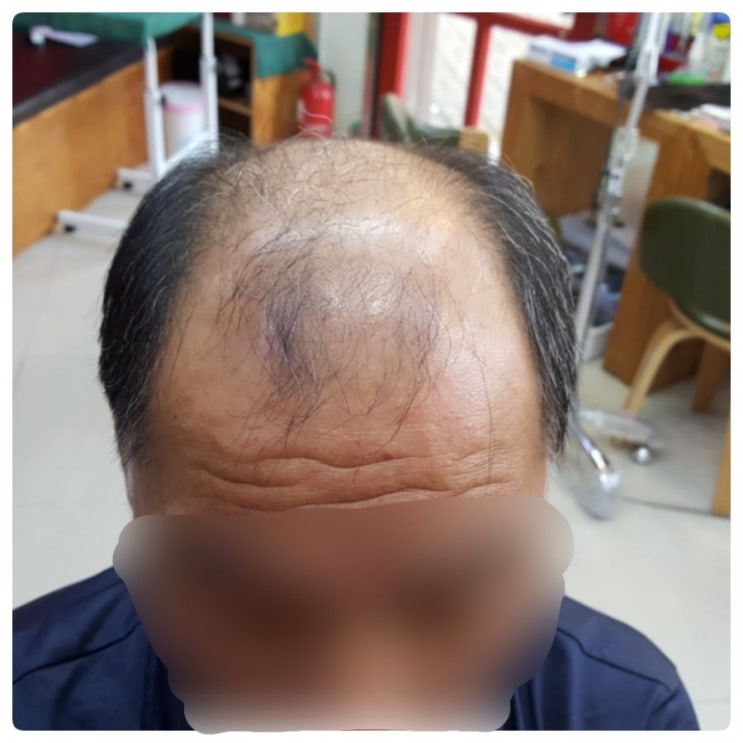  #김호증모가발#춘천가발#맞춤가발#남자가발#겨울준비하러 #모자벗고 #맞춤가발하러 왔어요~