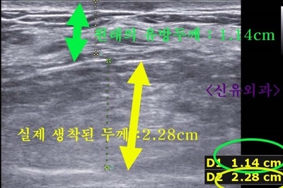 가슴지방이식부작용석회화멍울치료가 오히려 문제되어서 오신 분