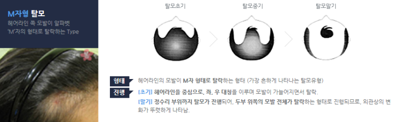 여자 M자 탈모증 초기증상예방법 루토닉앰플 7