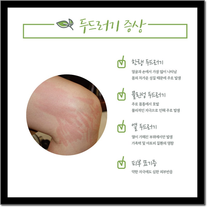 콜린성 두드러기 증상 발생 원인 From 수원