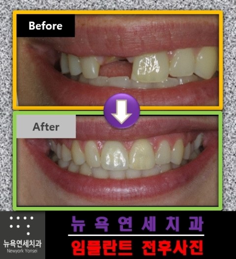 임플란트 수술로 잃어버린 치아를 되찾는 방법에 대해서...