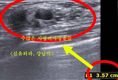 줄기세포자가지방 가슴이식 3차까지 했는데 3년만에 멍울과 통증으로 부작용석회화 치료받으심