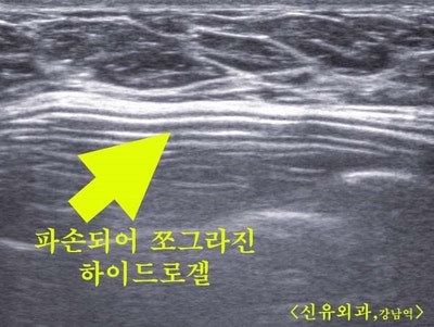 하이드로겔가슴보형물파손을 부분마취로 제거하고 늘어진 피막도 내시경으로 제거