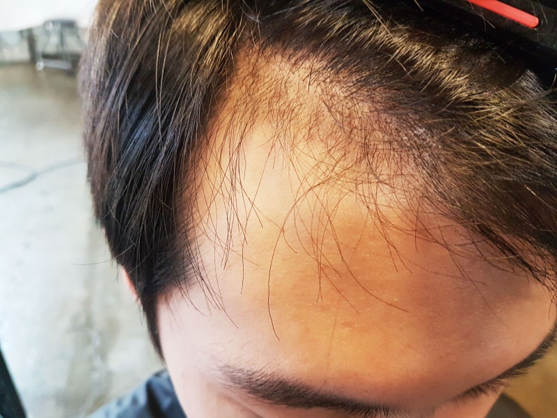 모발이식 후 염색, 펌, 탈색, 스프레이, 젤, 왁스
