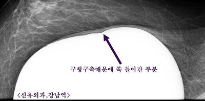 스무스와 텍스처가 섞여 있었던 분 가슴보형물교체하면서 거상술&맘모톰도 동시에.