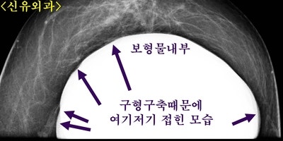 구형구축가슴보형물제거하면서 임신출산수유후 처진가슴올리는 거상술 동시 시행