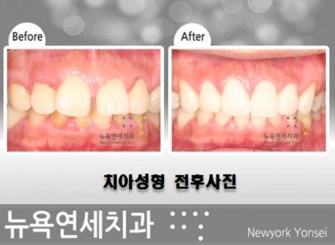  앞니를 치아성형하는 방법으로 라미네이트 시술의 사례 보기