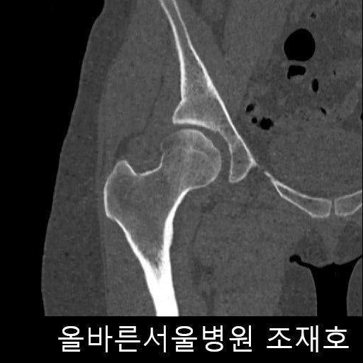 고관절 아치형 인대