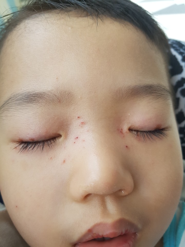  농가진 재발하다