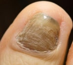 Thick toenails: Causes, symptoms, and treatments