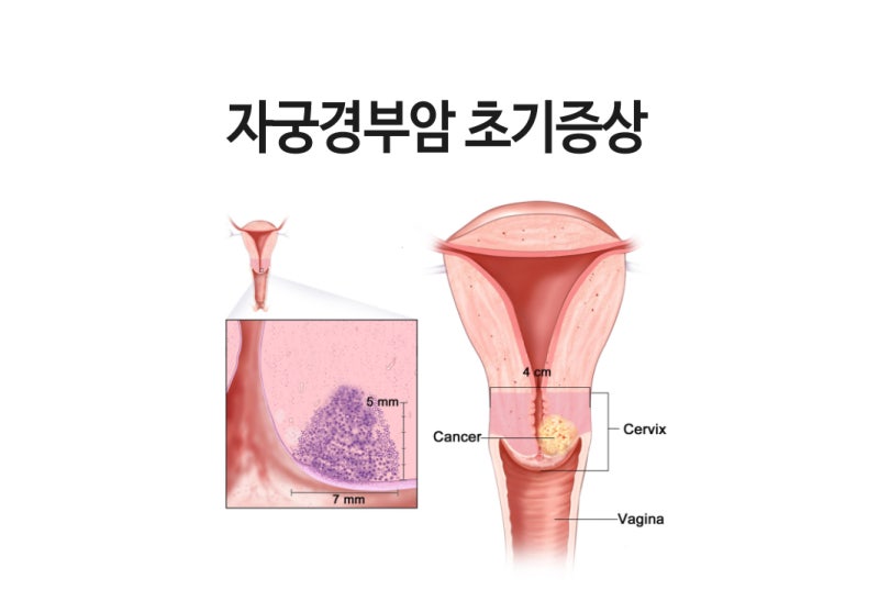 자궁암 초기증상 원인 위험신호 빨리 2