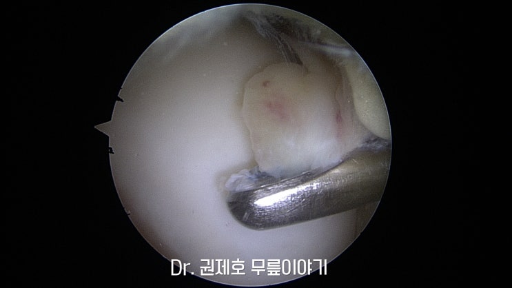  통풍으로 인한 무릎 관절염