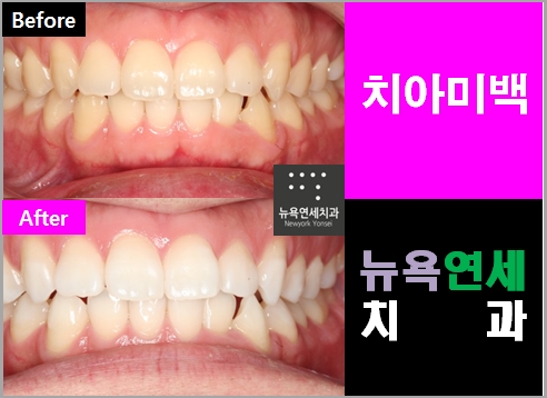  치아미백하면 어느 정도 효과를 볼 수 있을까요?