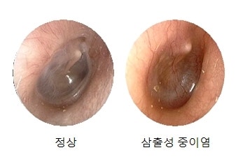아기 중이염의 원인